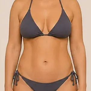 Resultado de lipoaspiração realizada pelo Dr. Sergio William, cirurgião plástico em Goiânia