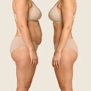 Resultado de lipoescultura realizada pelo Dr. Sergio William, cirurgião plástico em Goiânia