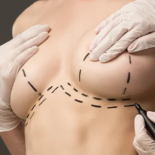 Resultado de mastopexia realizada pelo Dr. Sergio William, cirurgião plástico em Goiânia